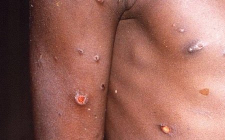 Viruela del Mono: ¿qué es y cuales son sus síntomas?